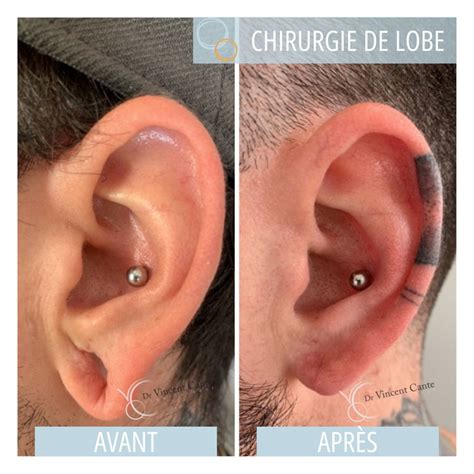 Schéma illustrant l'évolution du lobe d'oreille lors du stretching, mettant en évidence la taille de 10mm.