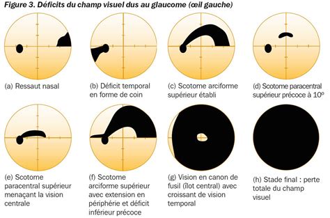 Comparaison visuelle : champ de vision d'une loupe 20x et 30x
