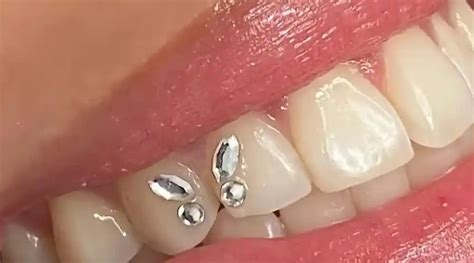 Schéma expliquant la pose d'un strass dentaire sur une dent avec les différentes étapes : nettoyage, application d'acide, pose de l'adhésif et fixation du bijou.