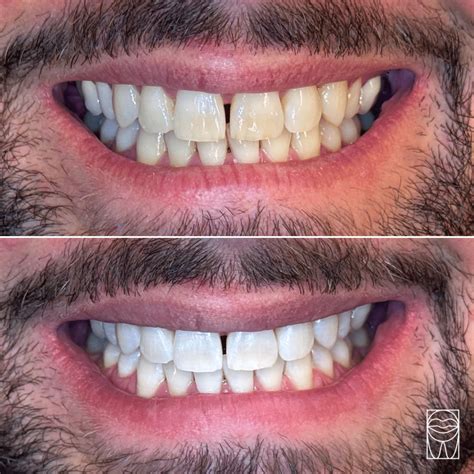 Avant/après illustrant l'effet d'un blanchiment dentaire sur l'éclat du sourire.