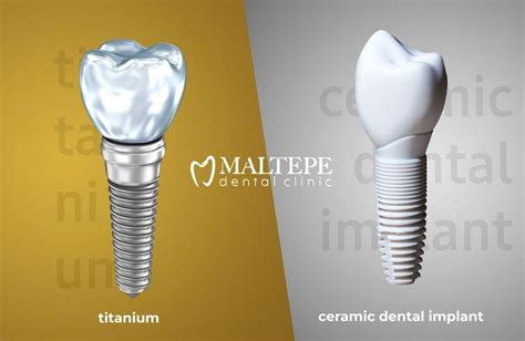 Schéma comparatif des implants dentaires en titane et en zircone, montrant leur structure et leurs composants.