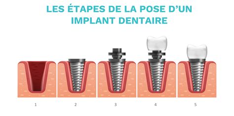 Infographie illustrant les étapes de la pose d'un implant dentaire en zircone.