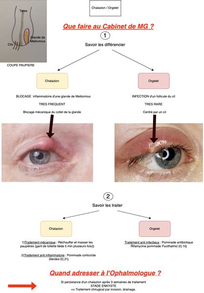 Illustration montrant la différence entre un orgelet et un chalazion.