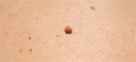 Comparaison visuelle des acrochordons avec d'autres types de lésions cutanées (verrues, grains de beauté).