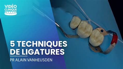 Illustrations des différentes techniques de boucles, ligatures et torsades de fil de fer