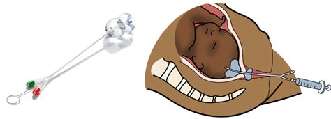 Illustration du Bijouprotec en action, montrant le pendentif et la méthode de déclenchement.