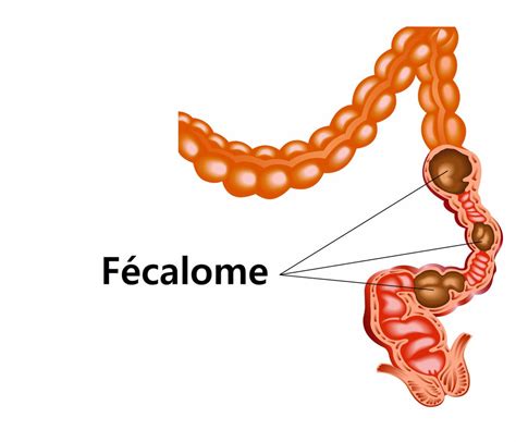 Infographie illustrant les différentes étapes du traitement d'un fécalome, du toucher rectal aux options chirurgicales.