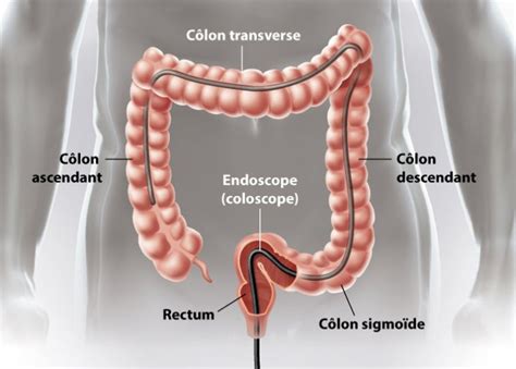 Image endoscopique montrant un polype colorectal.