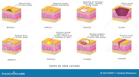 Illustration montrant différents types de lésions et taches sur les lèvres.