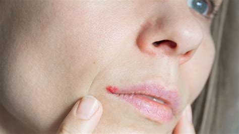 Image illustrant une chéilite angulaire avec fissures aux commissures des lèvres.
