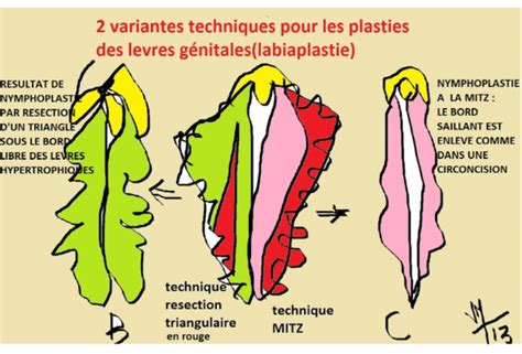 Schéma comparatif des petites et grandes lèvres avant et après nymphoplastie.