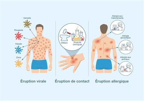 Illustration des différentes manifestations cutanées d'une allergie médicamenteuse
