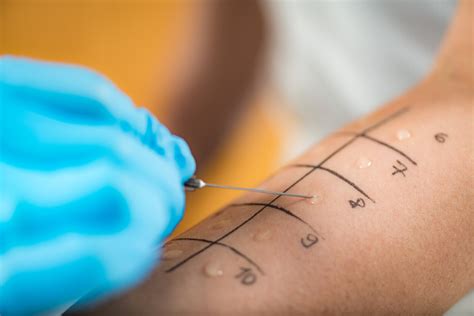 Illustration d'un test cutané pour une allergie médicamenteuse